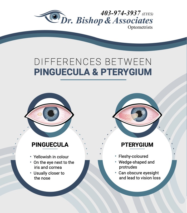 An infographic explaining the differences between pinguecula and pterygium.