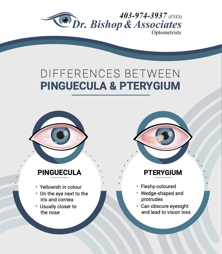 Pinguecula vs. Pterygium: What's the Difference?