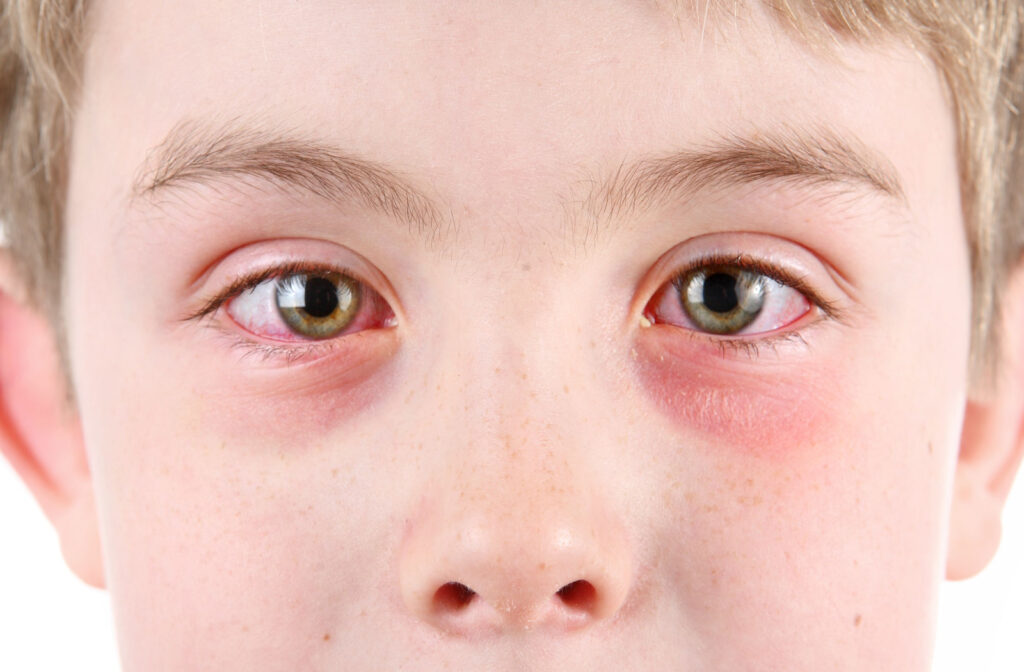 A close-up of a boy with irritated, red eyes.