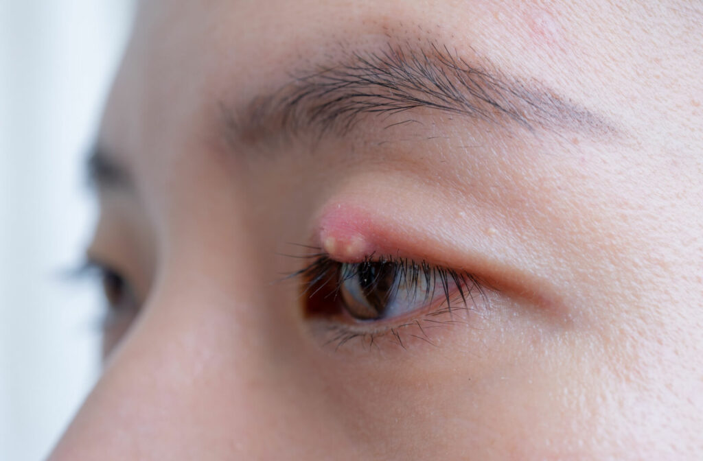 A close-up of a stye on an eyelid