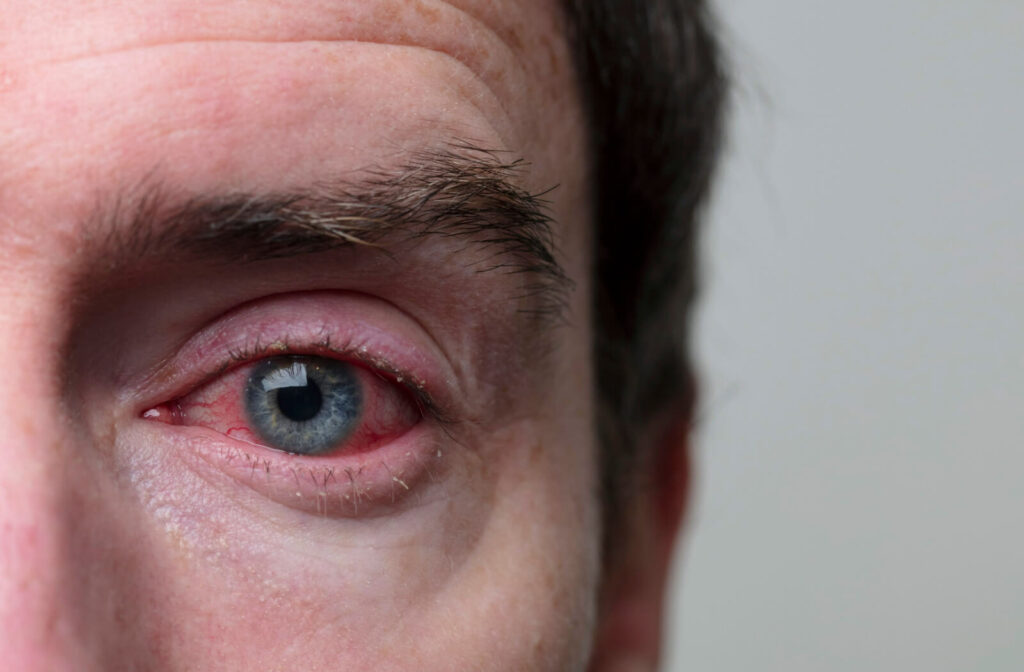 A close-up of a man's eye to show blepharitis infection on the eye.