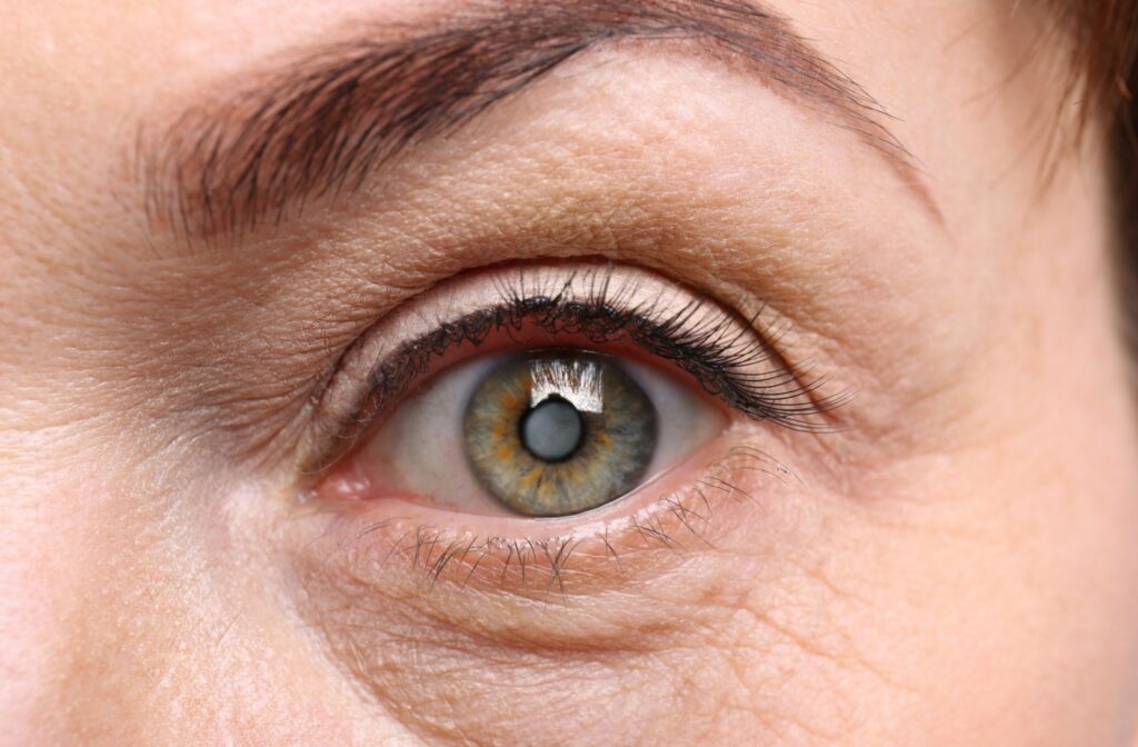 A close-up image of a female's left eye with a cataract.