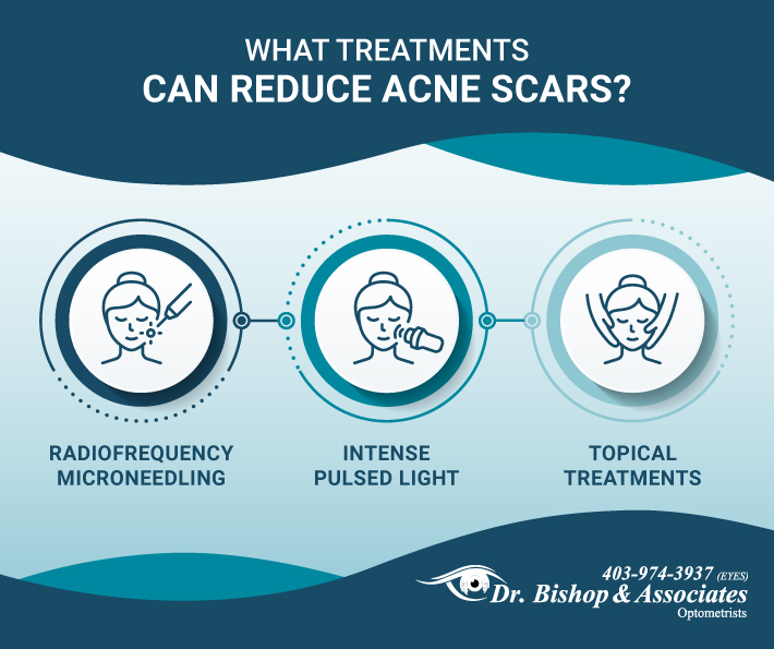 an infographic highlighting the treatments that can help reduce acne scars