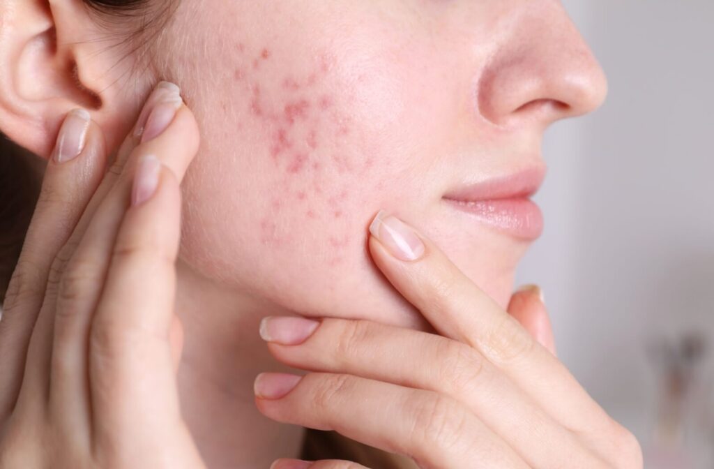 Close-up of the red acne scars on a person's cheek.