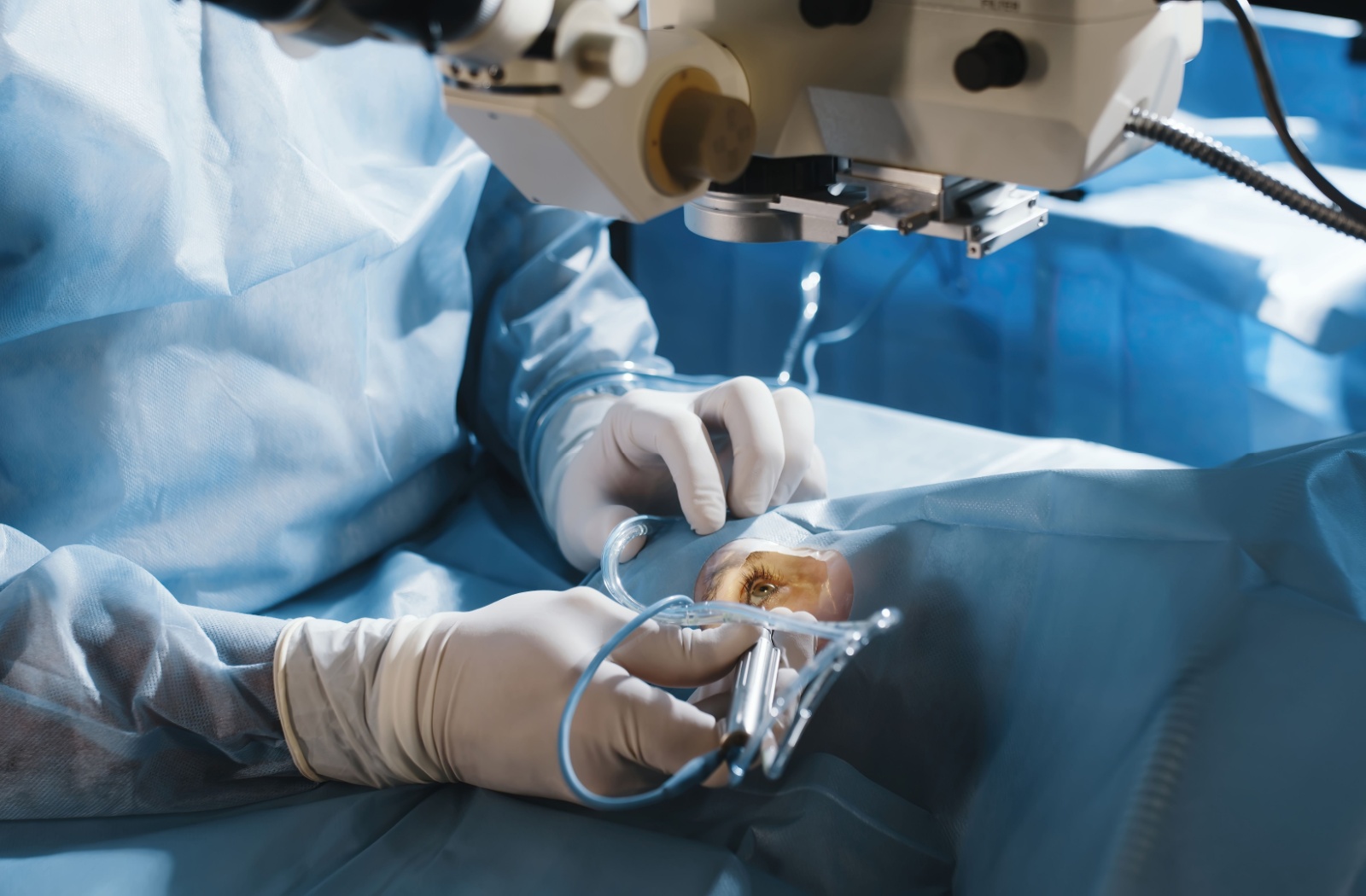 A patient stares up at a medical device as they lie on a table covered in protective material for cataract surgery.