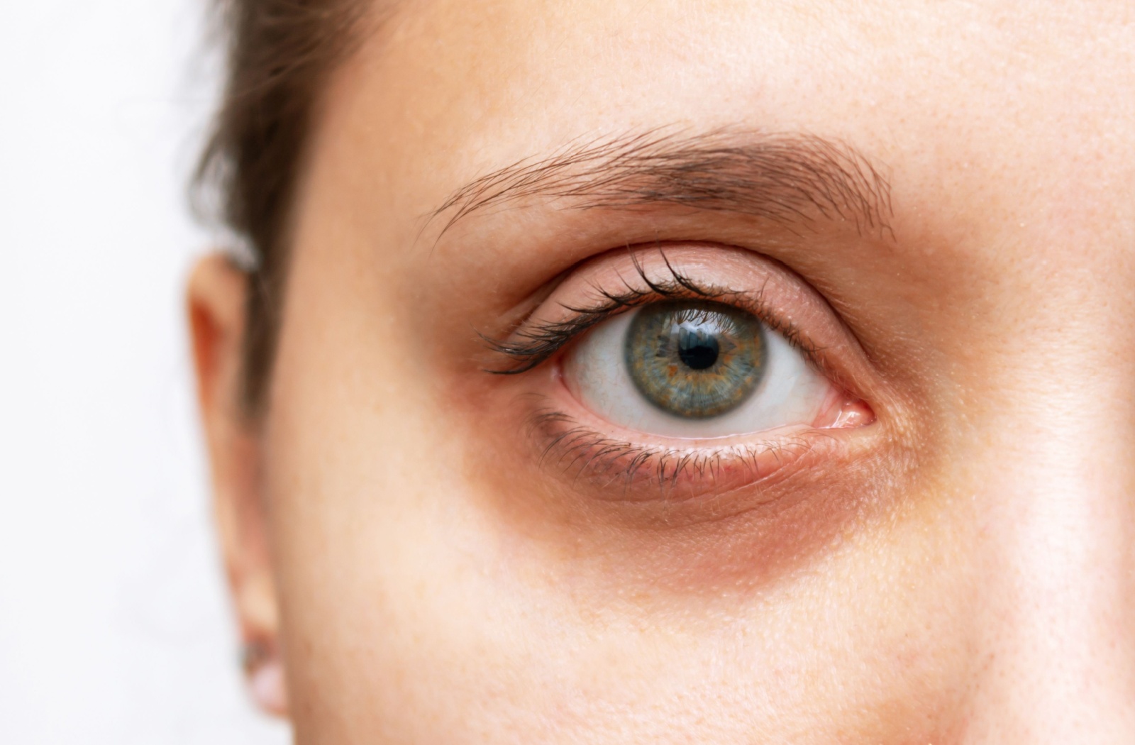 A close-up image of an adult with a dark circle under their eye.