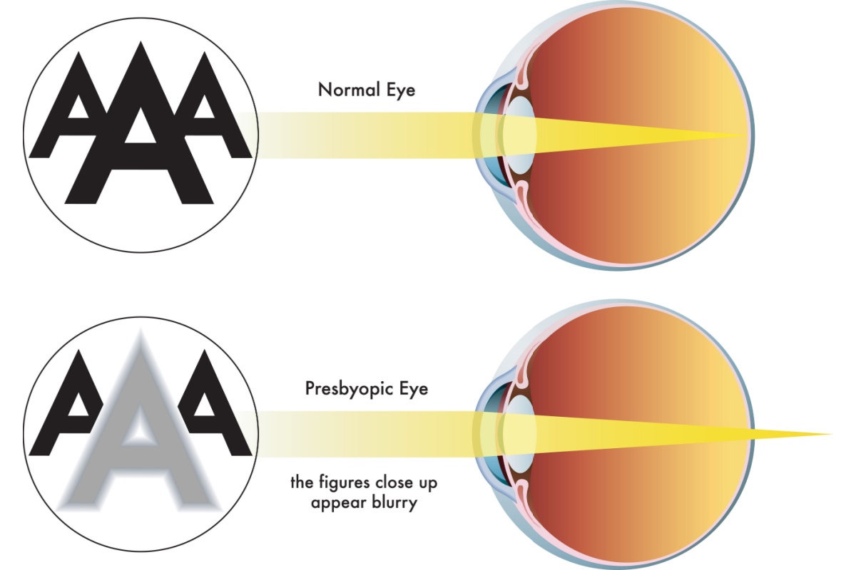 Illustration comparing normal near focusing to presbyopia, where the lens can no longer adjust to bring close objects into clear focus.