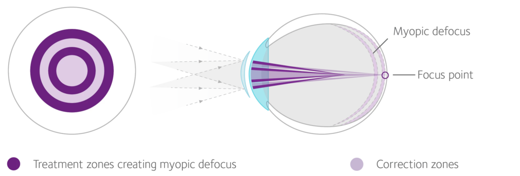 MiSight contact lens diagram showing alternating correction zones (light purple) for clear central vision and treatment zones (dark purple) that create peripheral myopic defocus, illustrated alongside a cross-section of an eye demonstrating how the lens focuses light to slow eye elongation.