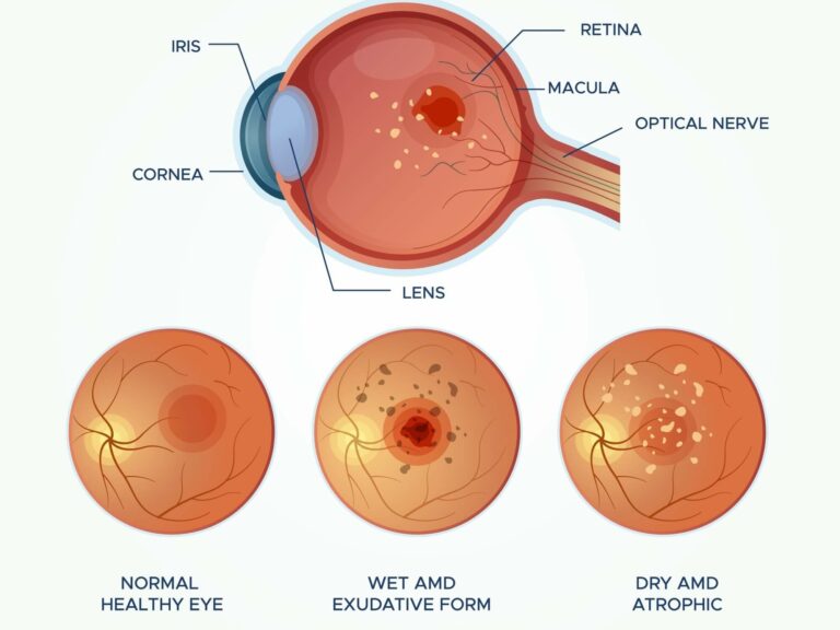 A labeled diagram of the human eye showing internal structures alongside three circular comparisons of a normal retina, wet macular degeneration, and dry macular degeneration with visible damage spots.