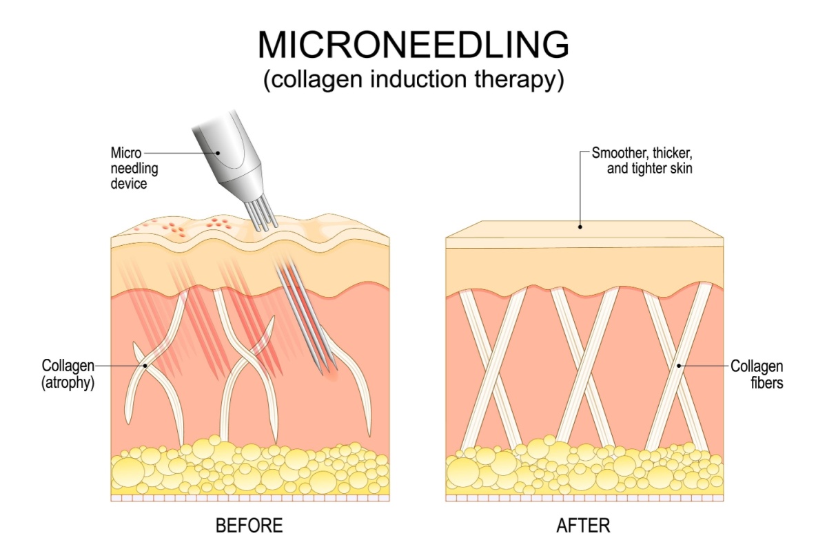 Microneedling cross section illustration for collagen.